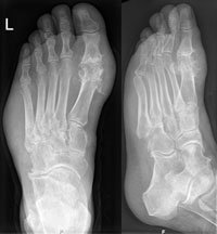 Gout Image