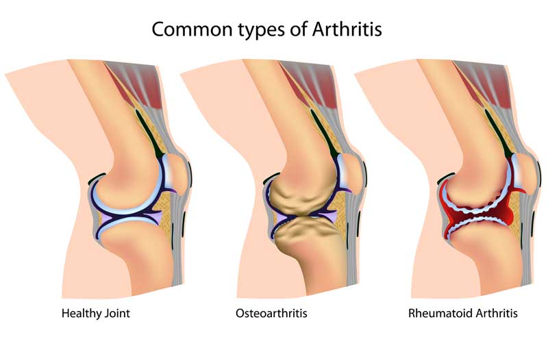 common-types-of-arthritis