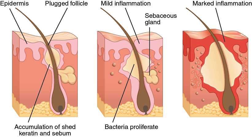 Mild-to-Moderate Acne 
