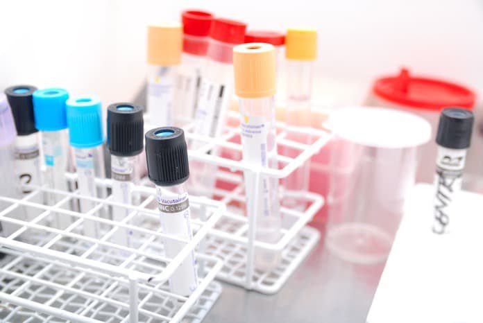 Investigating Two Drugs for the Prevention of Posttraumatic Osteoarthritis osteoarthritis